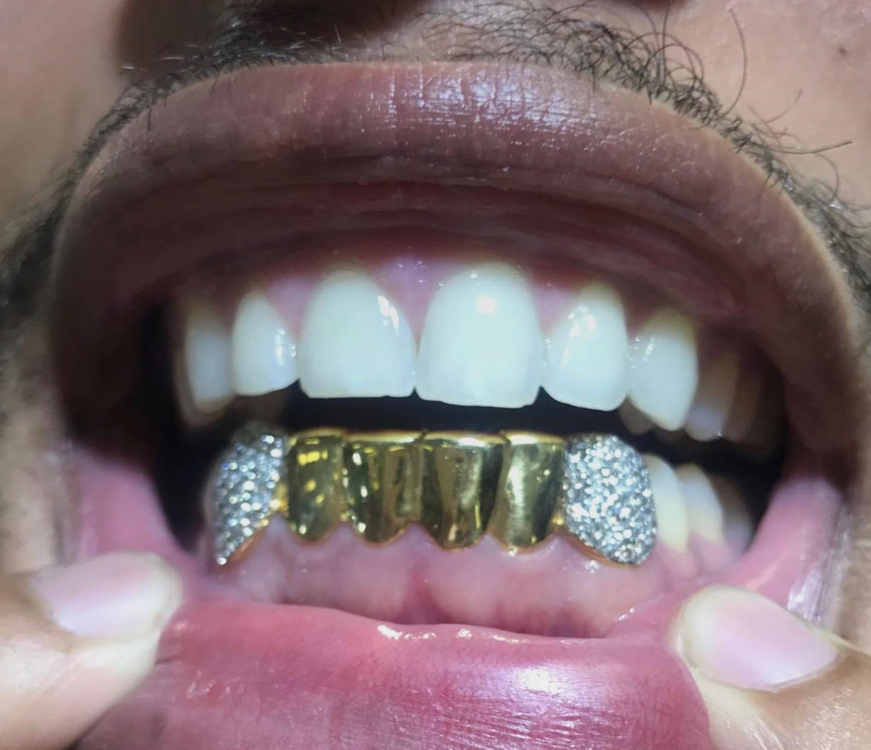 6 Piece Gold with 2 Diamond Fangs